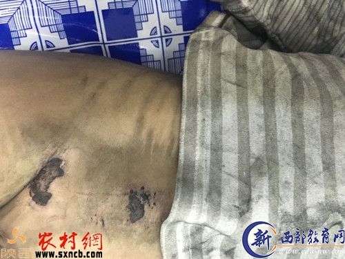 小孩肚脐部被烧伤的惨景