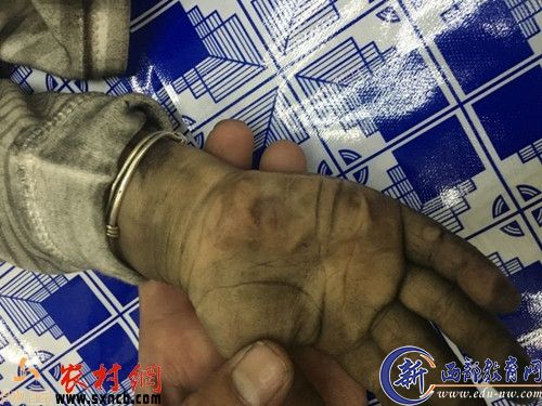 3岁男孩手部被烧的情景