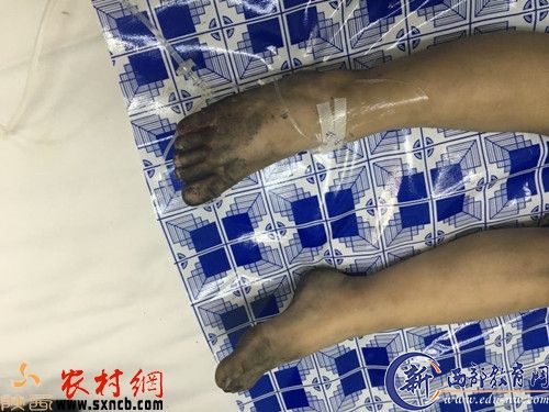 3岁男孩足部被大火烧伤的情景